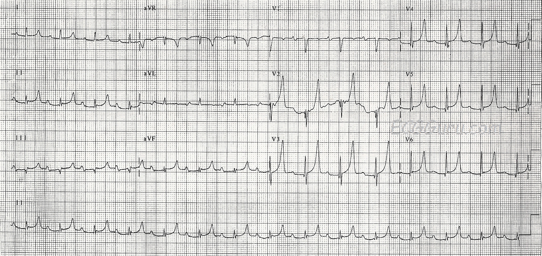 Hyperkalemia Ecg Guru Instructor Resources 